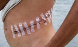 O-tráfico-de-órgãos1-300x180